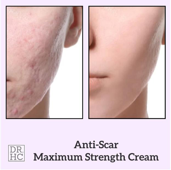 DRHC-Kem-tri-seo-Anti-Scar-2.jpg
